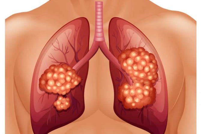 lung-cancer-1.jpg